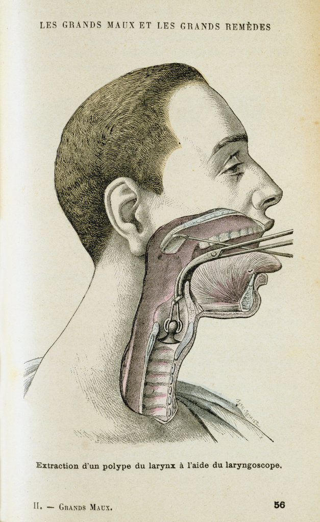 Detail of Using a laryngoscope to aid the removal of a polyp from the throat, c1890 by Unknown