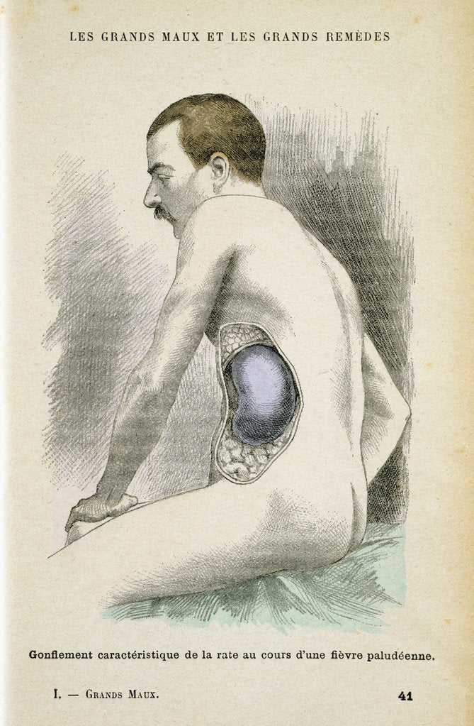 Detail of Typical enlarged spleen of a Malaria patient, c1890 by Unknown