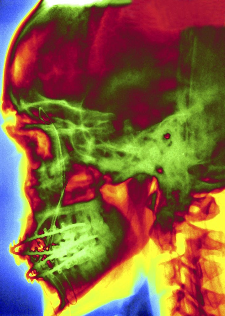 Detail of X-ray of Skull With Jaw Wiring by Corbis