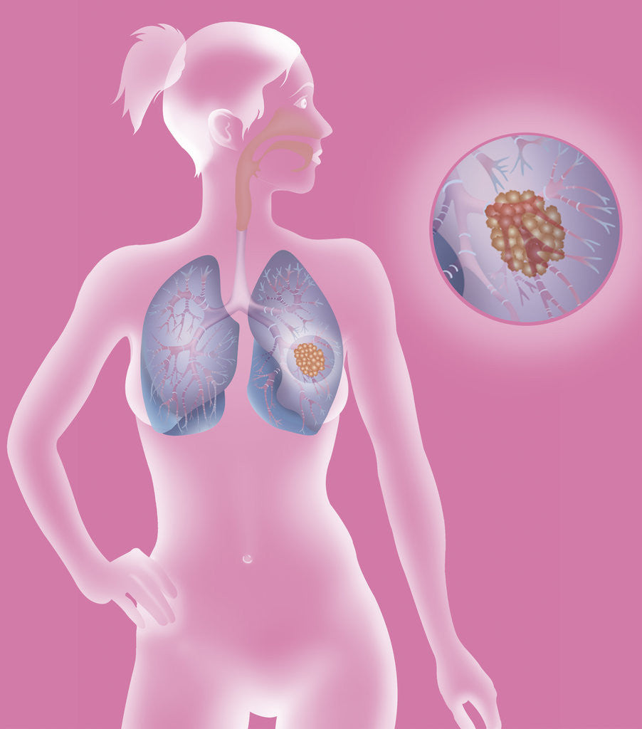 Detail of Lung cancer, drawing by Corbis