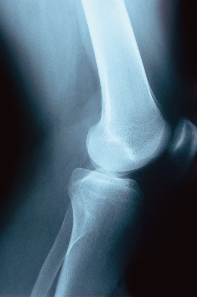 Detail of Knee Joint X-Ray by Corbis