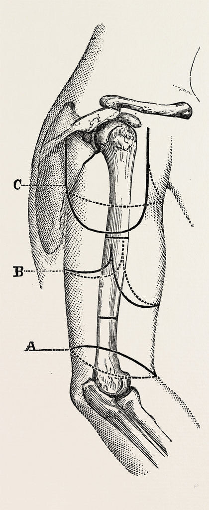 Detail of Circular (inclined) amputation by Anonymous