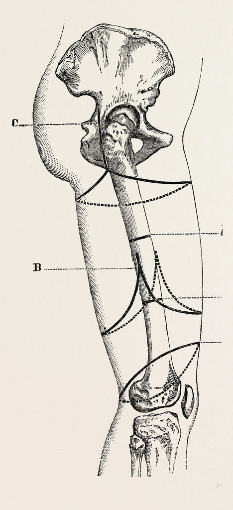 Detail of Circular amputation of thigh by Anonymous