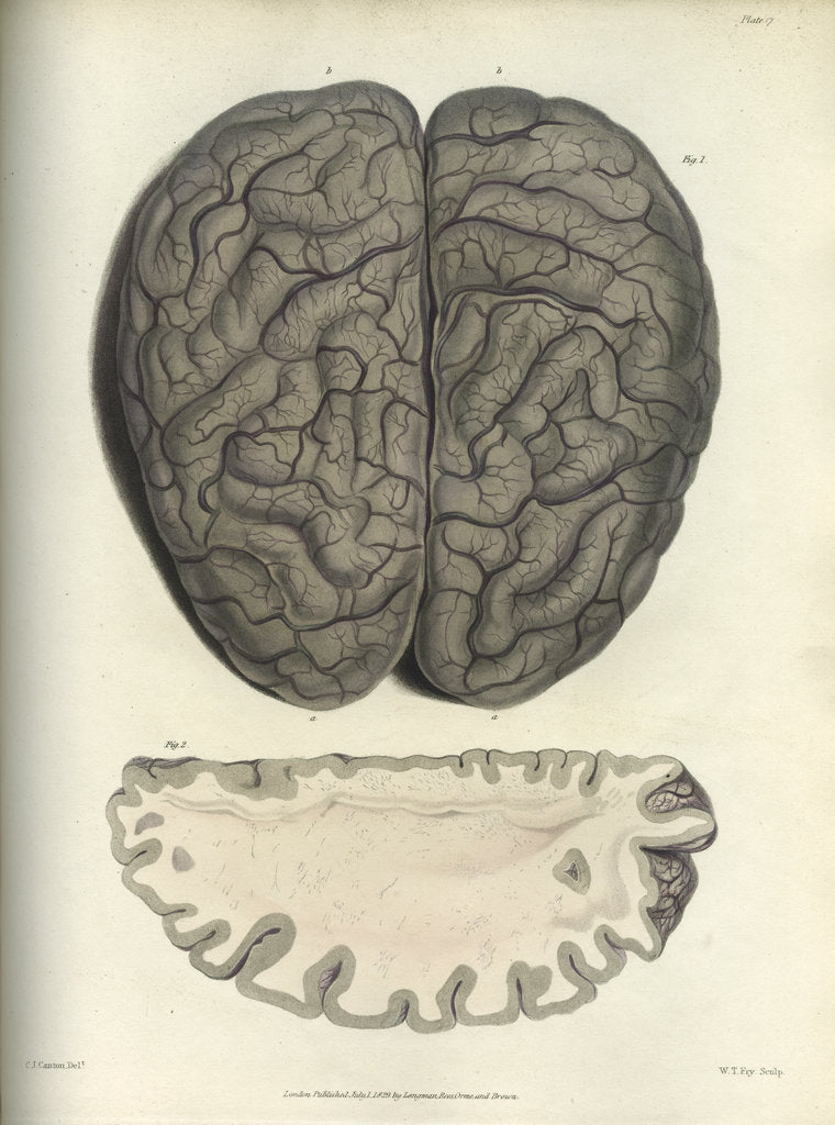 Detail of 'Extreme cerebral congestion' by William Thomas Fry